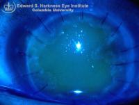 Epithelial defect post penetrating keratoplasty.